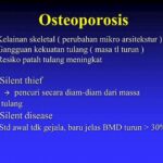 “pola Hidup Sehat Hindari Osteoporosis”