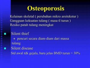 “pola Hidup Sehat Hindari Osteoporosis”