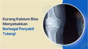 Kekurangan Kalsium Dan Keropos Tulang